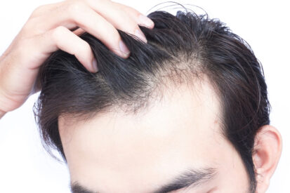 Why does hair loss occur?