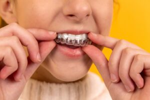 Frequently asked questions: Demystifying invisible aligners